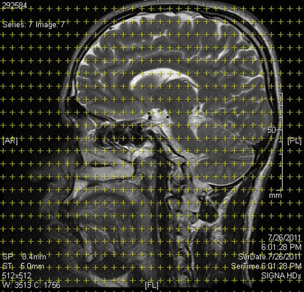 Stereological Grid Superimposed on a Brain MR Image