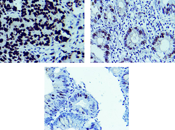 Expression of Ki67 in Adenocarcinoma (A), Adenomatous (B), and Normal (C) Human Colorectal Specimens (IHC, 400 × Magnifications)