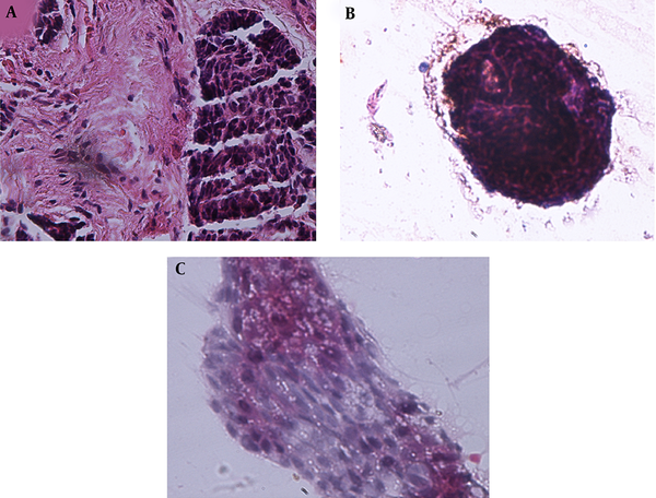 The Stages of Margin Control, Magnification of × 400; A, Positive margin by frozen section with Hematoxylin and Eosin staining; B, True-positive margin by Tzanck smear test with Pap staining; C, False-positive margin by Tzanck smear test with Pap staining.