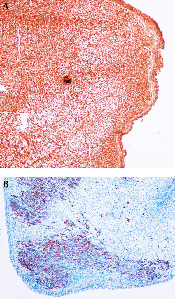 Positive Immunostaining for MyoD1 (A) and Desmin (B)