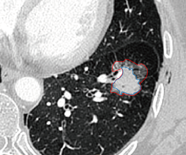 Semiautomated segmentation and volume measurement of sub-solid nodule (SSN) in a 63-year-old woman. Segmentation of solid portion and ground-glass portion on lung window (red line: SSN contour; blue line: the contour of the inner solid portion).
