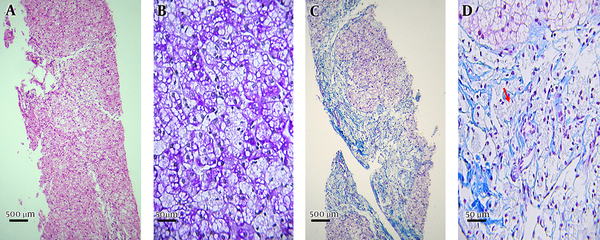 A, B, Fat micro-vesicles in hepatocytes and Kupffer cells; fibrotic transformation and bridge structures in portal areas; C, clusters of foamy macrophages resided in areas; D.