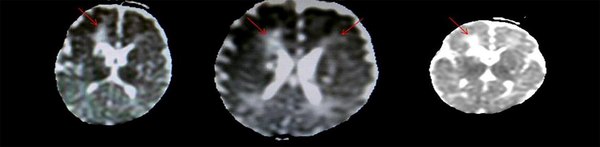 Brain MRI: Bilateral Periventricular Cyst and Abscess
