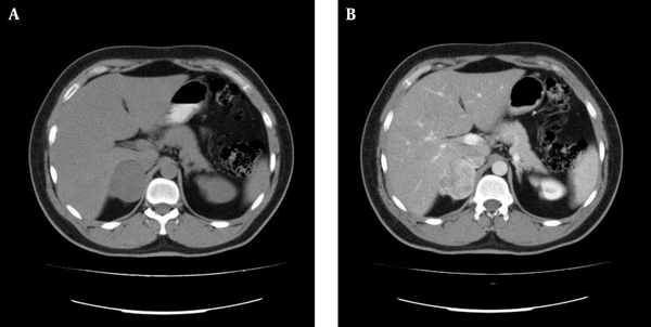 Un-Enhanced (A) and Contrast-Enhanced (B) Computed Tomography Scan Showed a Large Heterogenous Solid Mass in the Right Adrenal Gland