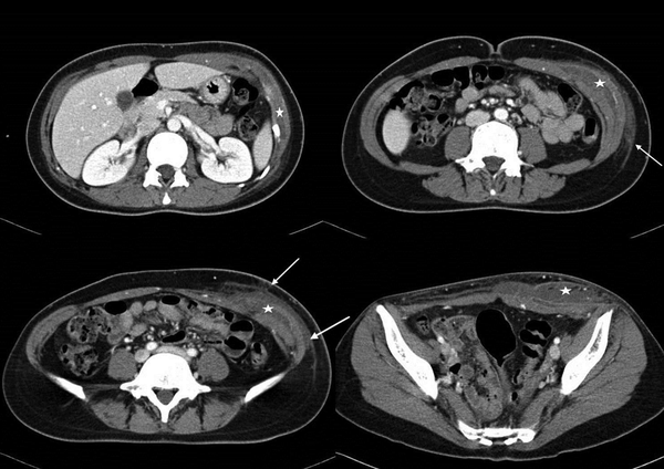 Radiologic features of abdominal computed tomography (CT). CT scan shows low attenuated fluid collection (star) in intermuscular and deep subcutaneous spaces with an accompanying ill-defined surrounding soft tissue infiltration (arrows) spreading from the left upper lateral abdominal wall down to the lower anterior abdominal wall.