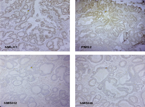 IHC study for hMLH1, hMSH2, hMSH6, and PMS2