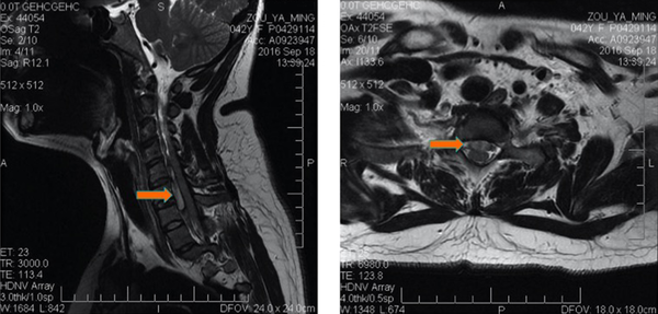 Initial T2-Weighted Sagittal (A) and Axial (B) Magnetic Resonance Images Showing a Hyperintense Acute Hematoma That Compressed the Spinal Cord in the Ventral Epidural Space at the C2-T3 Level