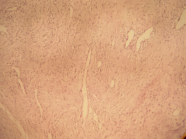 Spindle Cell Proliferation is Seen with No Pleomorphism, Mitotic Activity, Necrosis (H & E, × 100).