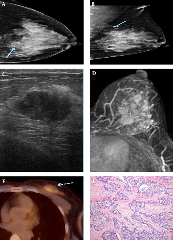 A 49-year-old female patient who presented with a palpable mass in the left breast. A and B, On mammography (A) craniocaudal (CC) view and (B) mediolateral-oblique(MLO) view, an irregularly shaped, indistinct marginated isodense mass (solid arrow) was seen in the left upper inner quadrant. C, An approximately 1.7-cm spiculated, oval-shaped hypoechoic mass was seen in the left breast in the 10 o’clock direction, 4 cm from the nipple on sonography. D, On axial fat-saturated T1-weighted 1-minute subtraction maximum intensity projection (MIP) imaging, multiple variably shaped masses with spiculated margins were seen, which all showed early rapid enhancement with delayed wash-out on dynamic study. E, These tumors exhibited increased FDG uptake (dashed arrow) on 18F-fluorodeoxyglucose  positron emission tomography-computed tomography (18FFDG  PET-CT). F, On microscopic examination (hematoxylin-eosin stain, original magnification x 100), the tumor is composed of cribriform or fenestrated cellular islands with smooth or angulated contouring. Extensive secondary lumen formation is observed, and some of the lumen is filled with eosinophilic secretion and occasional microcalcification. Unlike cribriform ductal carcinoma in situ (DCIS), desmoplastic stromal reaction is also observed in the background. The tumor cells show low grade of nuclear atypism and mitotic figures are rare. These cells have slightly enlarged nuclei with indistinct nucleoli.