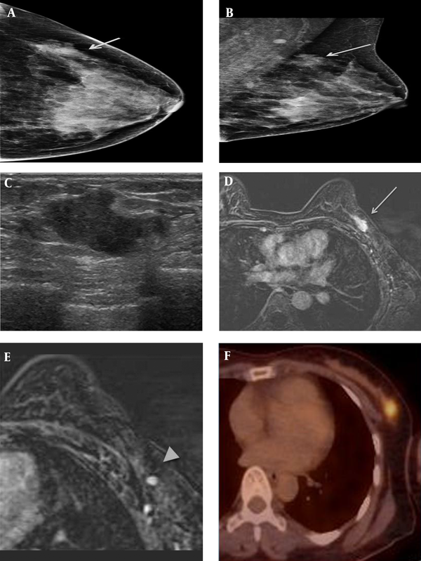 A 41-year-old female patient who presented with a palpable mass in the left breast. A and B, On mammography (A) craniocaudal (CC) view and (B) mediolateral oblique (MLO) view, an irregularly shaped, indistinct marginated isodense mass (solid arrow) was seen in the left upper outer quadrant, where the patient complained of a palpable mass. C, On sonography, an approximately 2.2-cm irregularly shaped, indistinct marginated hypoechoic mass was seen in the left breast in the 1 o’clock direction, 6 cm from the nipple. D&E, On axial fat-saturated T1-weighted 2-minute subtraction imaging, the mass (dashed arrow) was seen as an irregular marginated, oval-shaped mass with relatively homogeneous enhancement, measuring 2.1 × 1.1 cm in size. There was also a small enhancing lymph node with cortical thickening in the ipsilateral axilla (arrowhead). F, on 18F-fluorodeoxyglucose positron emission tomography-computed tomography (18FFDG  PET-CT) the mass was seen as a focal hypermetabolic lesion.