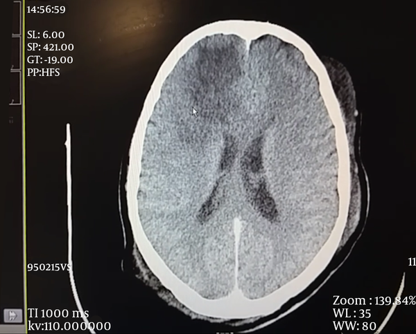 CT Scan After Treatment Demonstrated Improvements.
