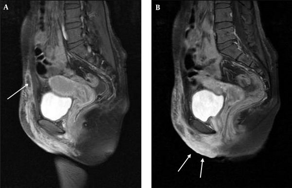Radiologic features of abdominal magnetic resonance imaging (MRI). A and B, Contrast-enhanced sagittal T1 weighted image (T1WI) demonstrates skin thickening and focal fluid collection (arrow) with ill-defined reticular streaky soft tissue enhancement, extending from the left lower abdominal wall to the vulva (arrows).