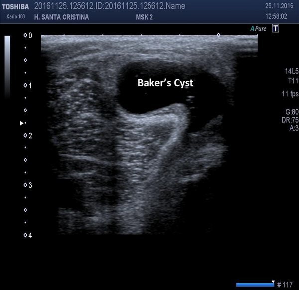 In the 1970s, Baker’s Cyst Was the First Indication for Evaluation of Ultrasound on Musculoskeletal Pathology.