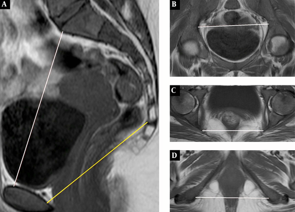  T1-Weighted spin-echo MR pelvimetric images. A, Sagittal, midline section shows sagittal inlet (obstetric conjugate) and sagittal mid-pelvis distance. B, Oblique axial section shows transverse inlet distance. C and D, Axial sections show transverse mid-pelvis and transverse outlet distance.