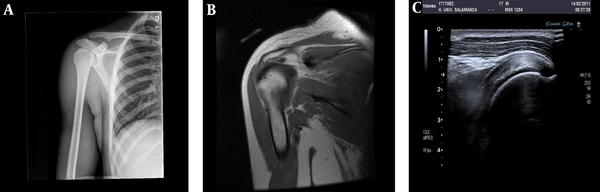 Shoulder evaluation: Radiography (A) and MRI (B) images have an anatomic representation, however, on an US (C), images are harder to understand.