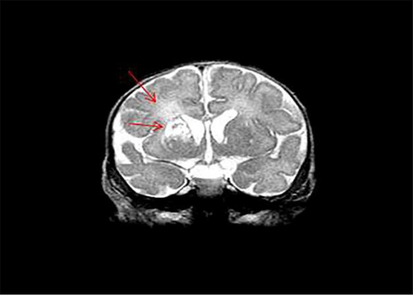 Braim MRI: Bilateral Periventricular Cyst Formation Mainly on the Right Side of the Caudate and Putamen