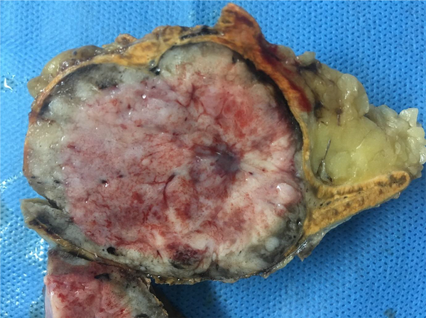Gross Specimen of the Adrenal Tumor: A Solid and Yellow Oval Mass