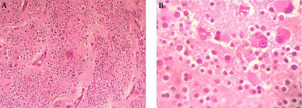 Histologic Examination of the Surgical Specimen Shows Neuroblasts and Ganglion Cells: (A) H and E (× 100); (B): H and E (× 400)