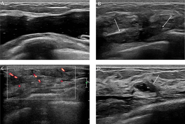Breast ultrasound reveals fluid like filler collection in a retroglandular, prepectoral location. A, US of the right breast shows a large amount of anechoic filler collection with internal multiple echogenic foci. B, the left filler collection demonstrates a marked decrease in volume (arrows), ill-defined margin, and heterogeneous internal echogenicity. C, on Doppler, increased vascularity is noted at left lower outer tender area. D, Anechoic isolated filler collection (arrow) is noted at relative value scale update committee (RUC).
