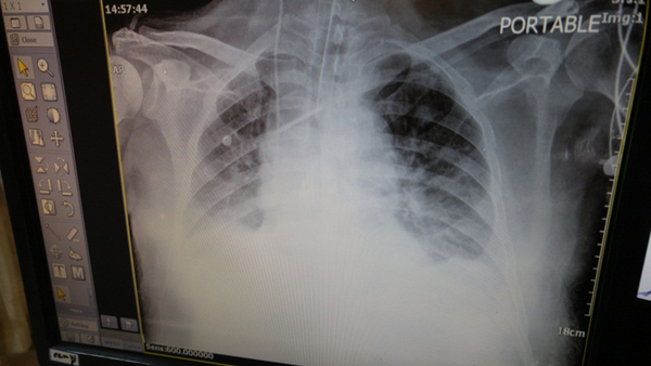 Chest X-Ray Showed Infiltration in the Lung Base and Bilateral Pleural Effusion.