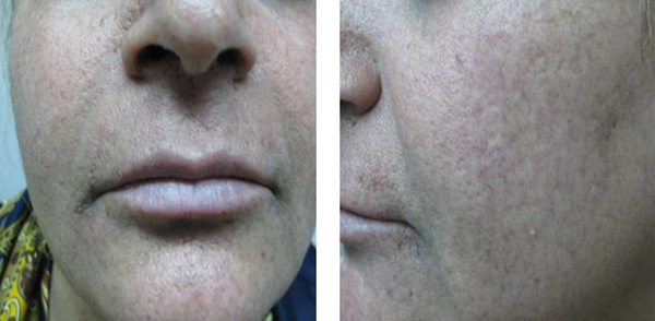 The improvement of hyperpigmentations and scars was significant within 3 months.