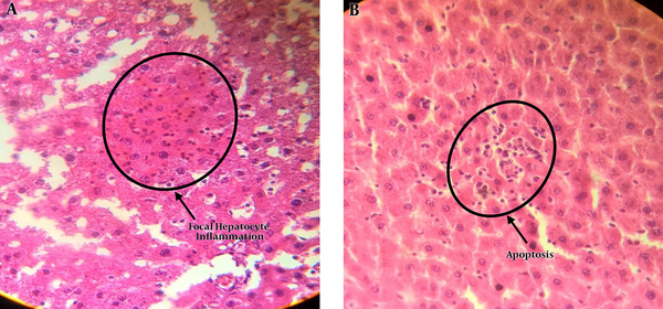 Microscopic Image (40 ×) of Liver Tissue in Rats Exposed to 1 mT Magnetic Field for 2 Weeks, Which Shows Focal Hepatocyte Inflammation (A) and Apoptosis (B)
