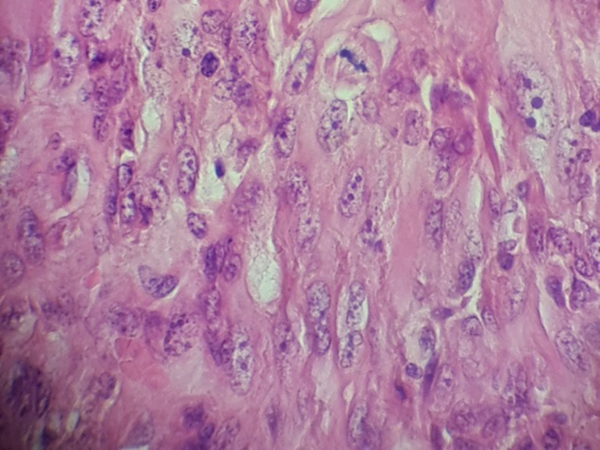 Spindle Cells in Streaming and Fascicular Pattern that Sometimes Demonstrated Epitheloid Appearance, Pleomorphism, Hyperchromatism, and a Lot of Mitoses (400 x).