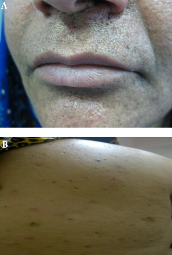 A Pitted Scars of Varying Sizes; B, Double Comedo-Like Lesions with 1 - 3 mm Diameter Around the Periorificial and the Back
