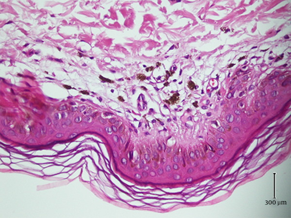 Moderate Melanin Incontinence and Some Evidence of a Late Lichenoid Reaction, Such as Focal Hydropic Change of Basal Epithelial Cells and Aggregation of Cytoid Bodies in the Papillary Dermis.