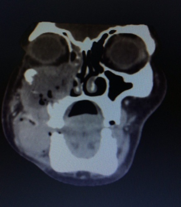 A Large Destructive Lesion with Irregular Margins That Filled the Right-Side Maxillary Sinus Infiltrated to Nasal Cavity, Lateral and Inferior Wall of Orbit, Masseter Muscle as Well as Alveolar Process and Internal Region of Low Attenuation Corresponding to Areas of Necrosis.