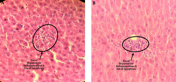 Microscopic image (40 ×) of liver tissue in rats exposed to 0.5 mT magnetic field for 1 month, which shows focal hepatocyte inflammation, parenchymal hepatocitolysis, and Focal Apoptosis (A and B)