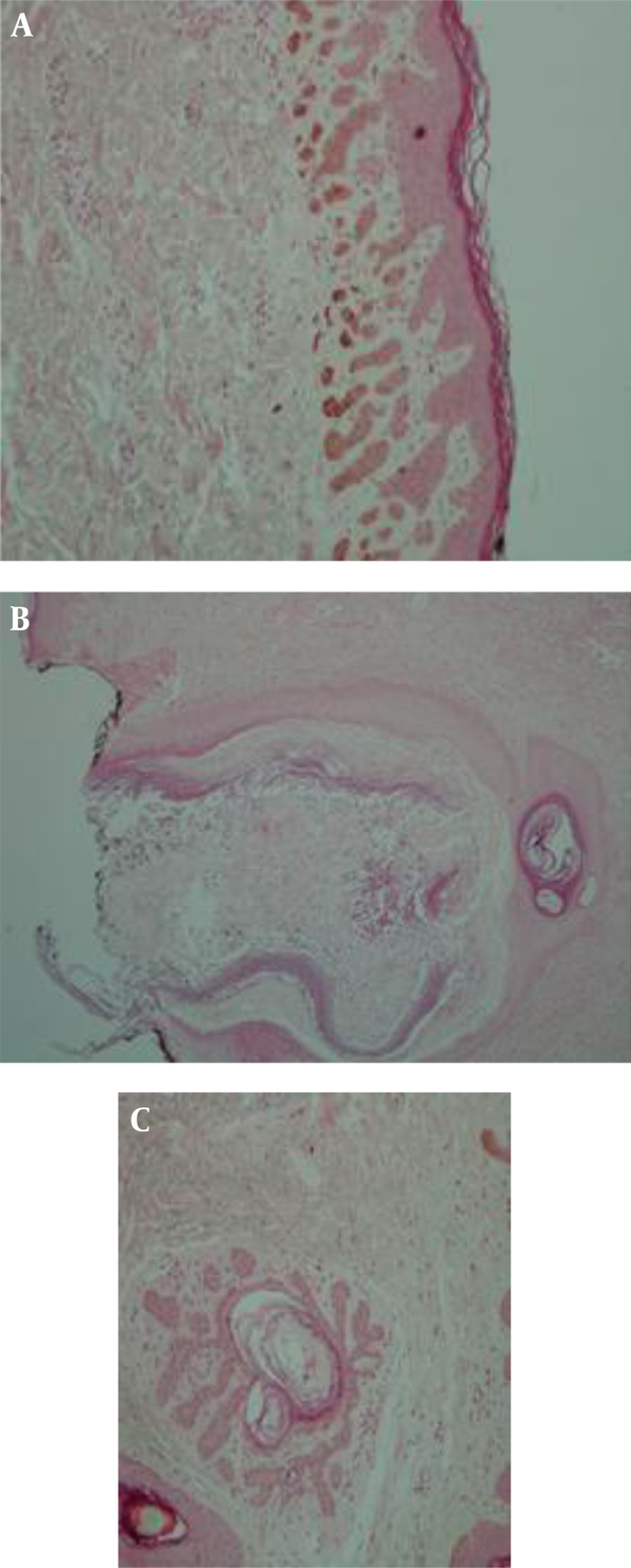 A, Hyperpigmentation of Basal Layer with Filiform Epithelial Growths Into the Dermis; B, Dilated Hair Follicle Containing Lamellar Keratinous Material and Foreign Body Type Giant Cell Reaction and Mixed Inflammation; C, Antler-Like Pattern.