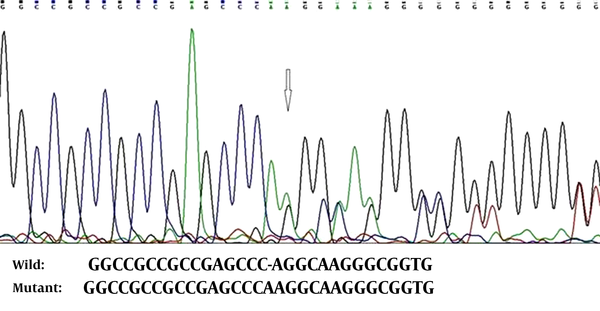 TheNM_023067:c.102_103insA (p.G35Rfs*61) Mutation in the FOXL2 Gene in the Patients of the First Family.