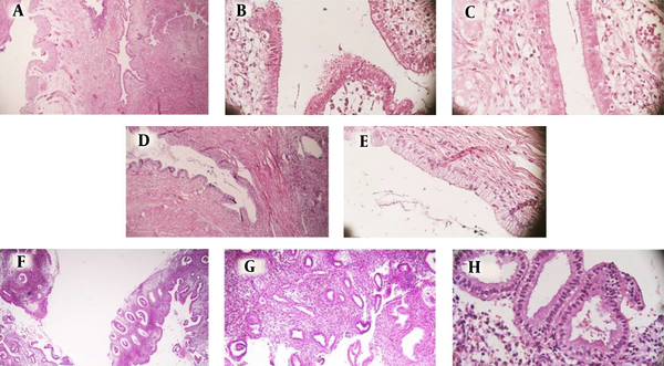 A, B, and C, Low and High Power Fields of Endosalpingiosis, Ectopic, Cystic Glands in the Bladder Mucosa are Seen That are Lined with Fallopian Tube-Type Ciliated Epithelium. Bladder Mucosa Can Be Seen in the Left Side of the Field; D and E, Low and High Power Fields of Edocervicosis, Ectopic Glands in the Bladder Mucosa are Seen that are Lined with Endocervical-Type Epithelium; F, G, and H, Low and High Power Fields of Endometriosis, Ectopic Endometrial Glands and Stroma in the Bladder Mucosa Are See.