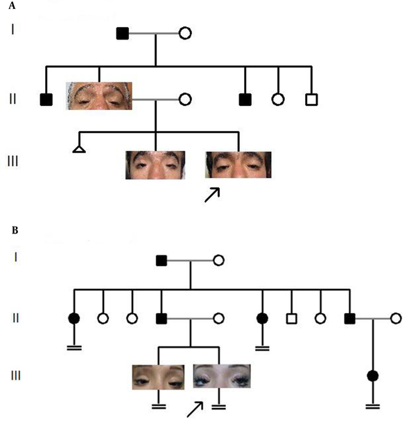 The probands are shown by arrows. There are six male patients in the first family (A) and eight patients (three males and five females) in the second family (B) all with eyelid abnormalities. Also infertility was observed in all female patients in the second family (B). The provided patients’ figures are related to 3 males and 2 females in the first and second families respectively.