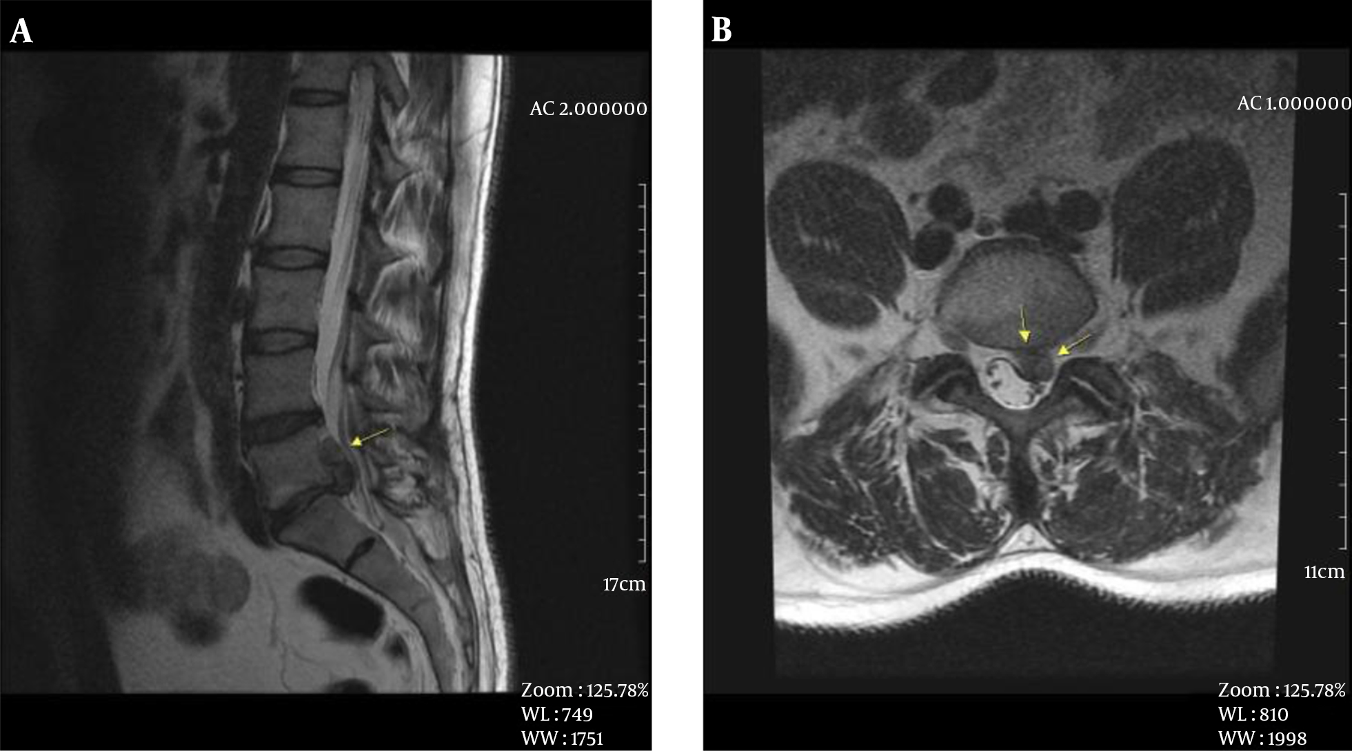 A 38 year-old man, A, mid-sagittal T2W-FSE image, degenerative signal and high loss and disc extrusion are seen at L5-S1 level (arrow). B, Axial T2W-FSE image, left subarticular zone disc extrusion and S1 nerve root impingement are detected at L5-S1 level (arrow).