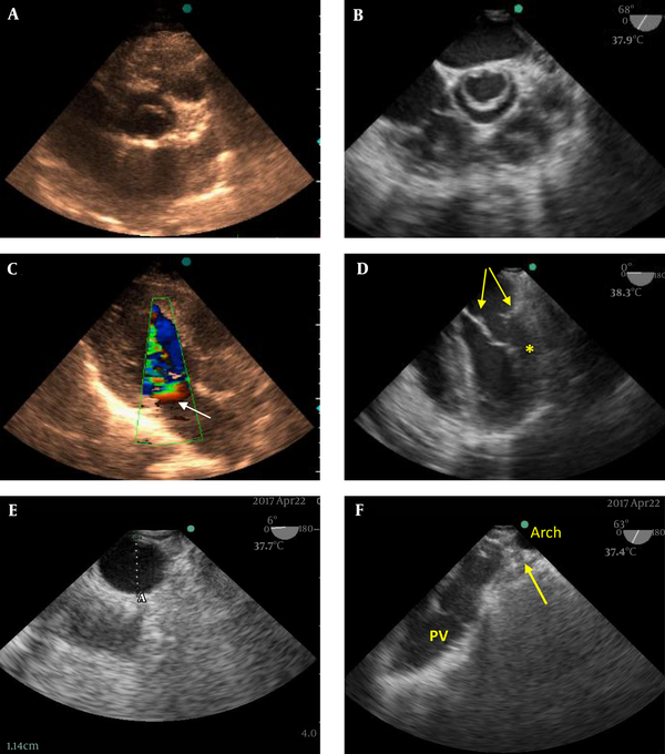 A, Short Axis Mid-Systolic View of Aortic Valve in Transthoracic Echocardiography Shows Unicuspid Aortic Valve; B, The same view in intraoperative transesophageal echocardiography (IOTEE) in which the unicuspid valve is better appreciated; C, Color Doppler imaging of the mitral valve apparatus in the transthoracic three chamber view: the formation of a PISA cap (arrow) is in favor of significant stenosis; D, A mid diastolic frame of the IOTEE four-chamber view shows the supravalvular ring in left atrium (arrows) and parachute mitral valve deformity in which all the chordae are inserted to the anterolateral papillary muscle (asterisk); E, Short axis view of descending aorta by IOTEE showed a small underdeveloped descending aorta; F, High esophageal aortic arch short axis view of IOTEE showing the site of previous division of the patent ductus arteriosus (arrow).