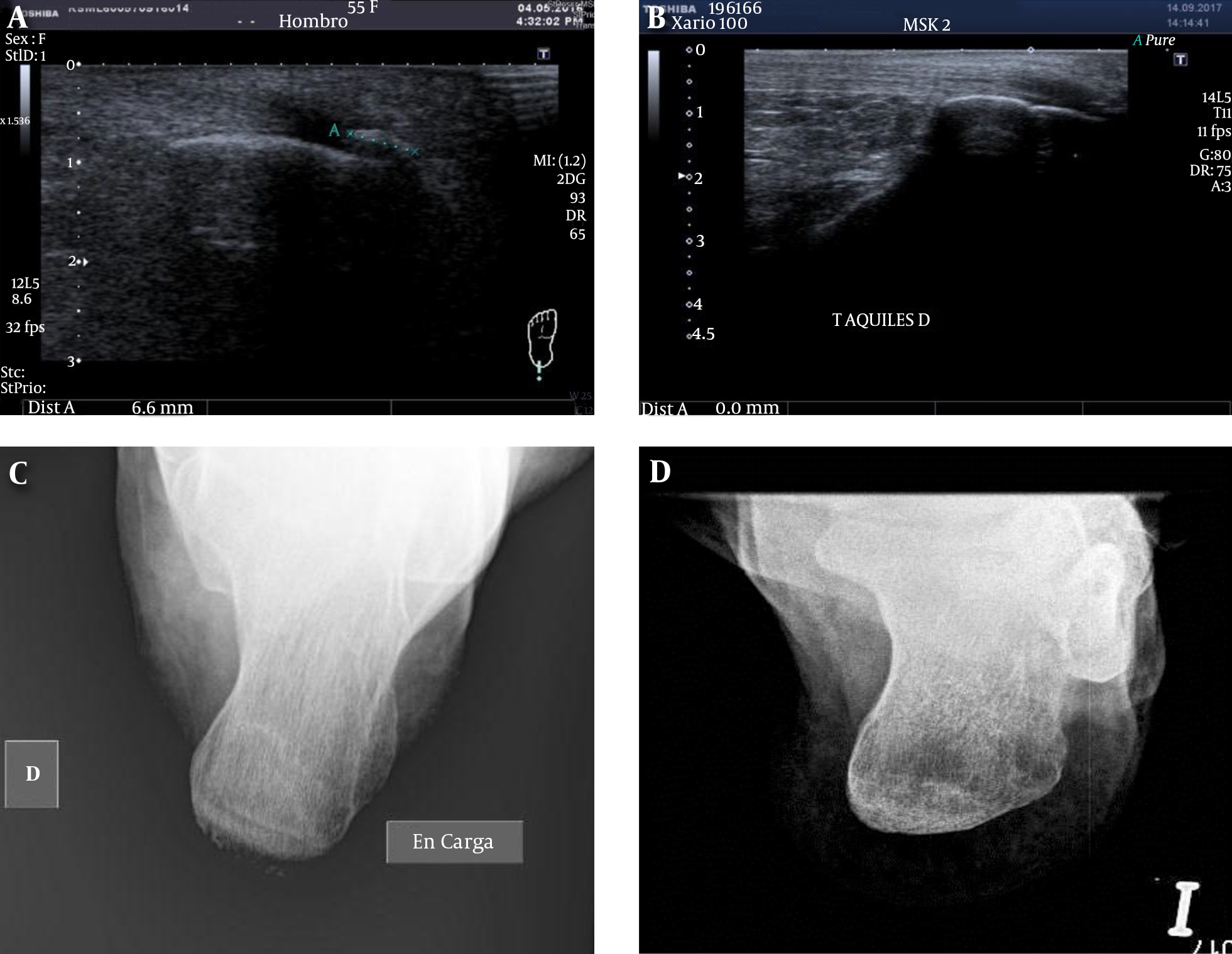 Before treatment: pain measured by VAS 5/10, calcification 6.6 mm evaluated by sonography (A) and radiography (C). After treatment: pain measured by VAS 0/10, calcification 0 mm evaluated by sonography (B) and radiography (D).