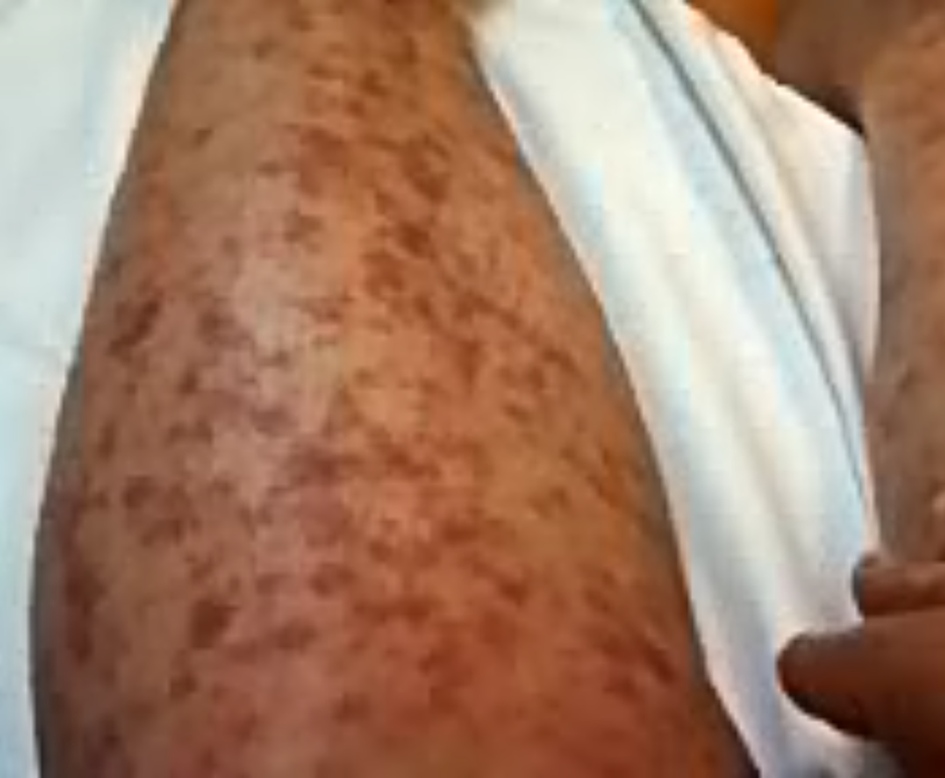 Patient’s Blanchable Maculopapular and Petechial Rash
