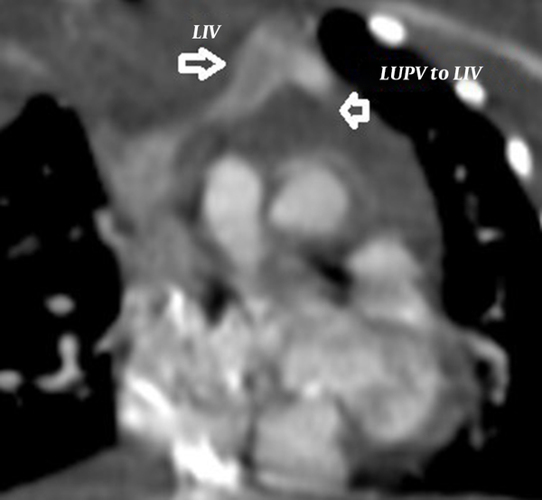 Frontal view in CT angiography, Left Upper Pulmonary Vein Connection (LUPV) to Left Innominate Vein (LIV)