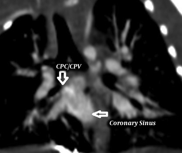 Frontal view in CT angiography, Confluence of Pulmonary Veins (CPV) or Common Pulmonary Chamber (CPC) to Coronary Sinus