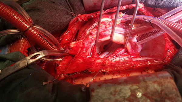 Surgical View Showing the Supravalvular Ring in the Left Artium
