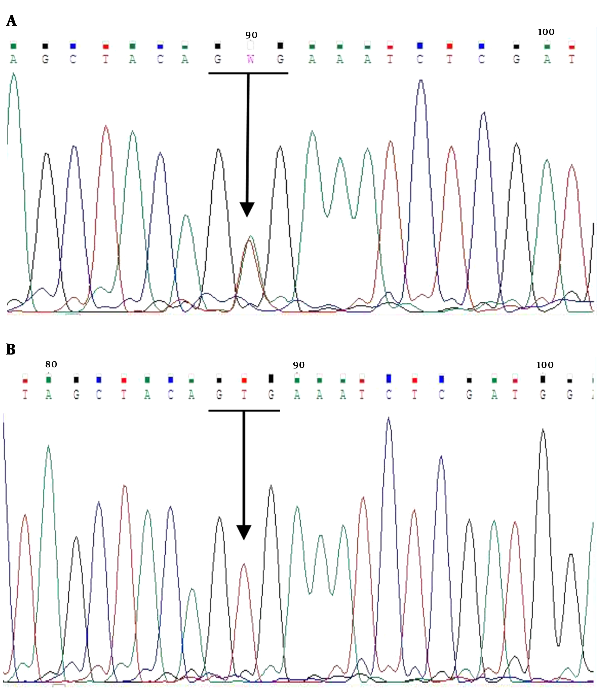 Sequence Data of the Amplified BRAF Gene; A, BRAF V600E (+), B, BRAF V600E (-)