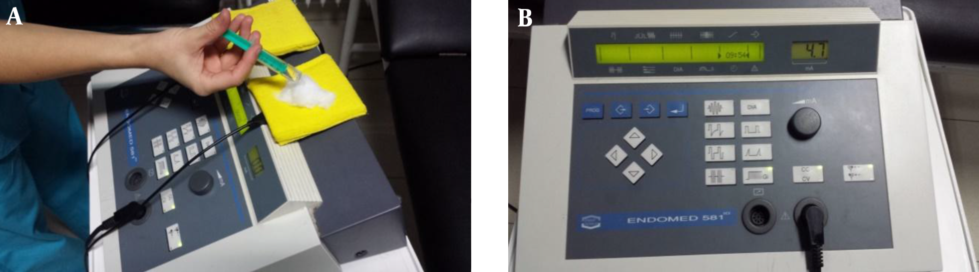 Acetic Acid 5%, 2 mL in a Gauze (A) are Dropped at the Cation Electrode (Negative Electrode), For Iontophoresis Treatment, a Galvanic Current at 4.7 mA Intensity Was Applied for 10 Minutes (B)