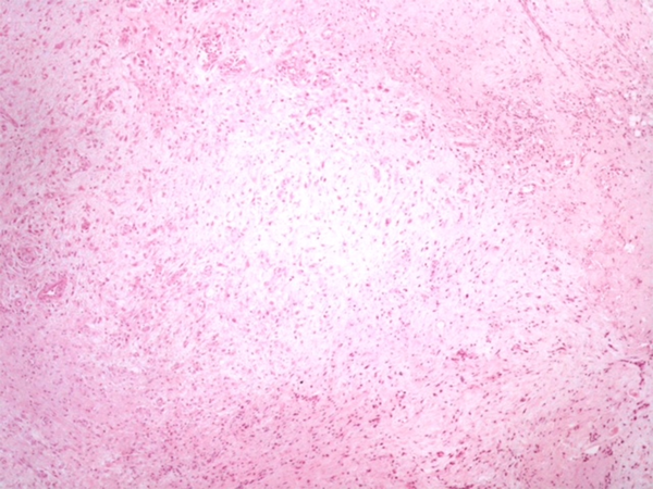 Hematoxylin & Eosin Staining Shows Accumulation of Mucinous Material in the Upper & Mid Dermis with a Mild Increase in Fibroblasts