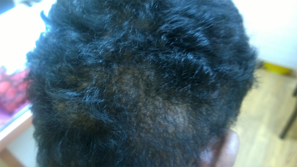 Hair Loss in Affected Areas of the Scalp