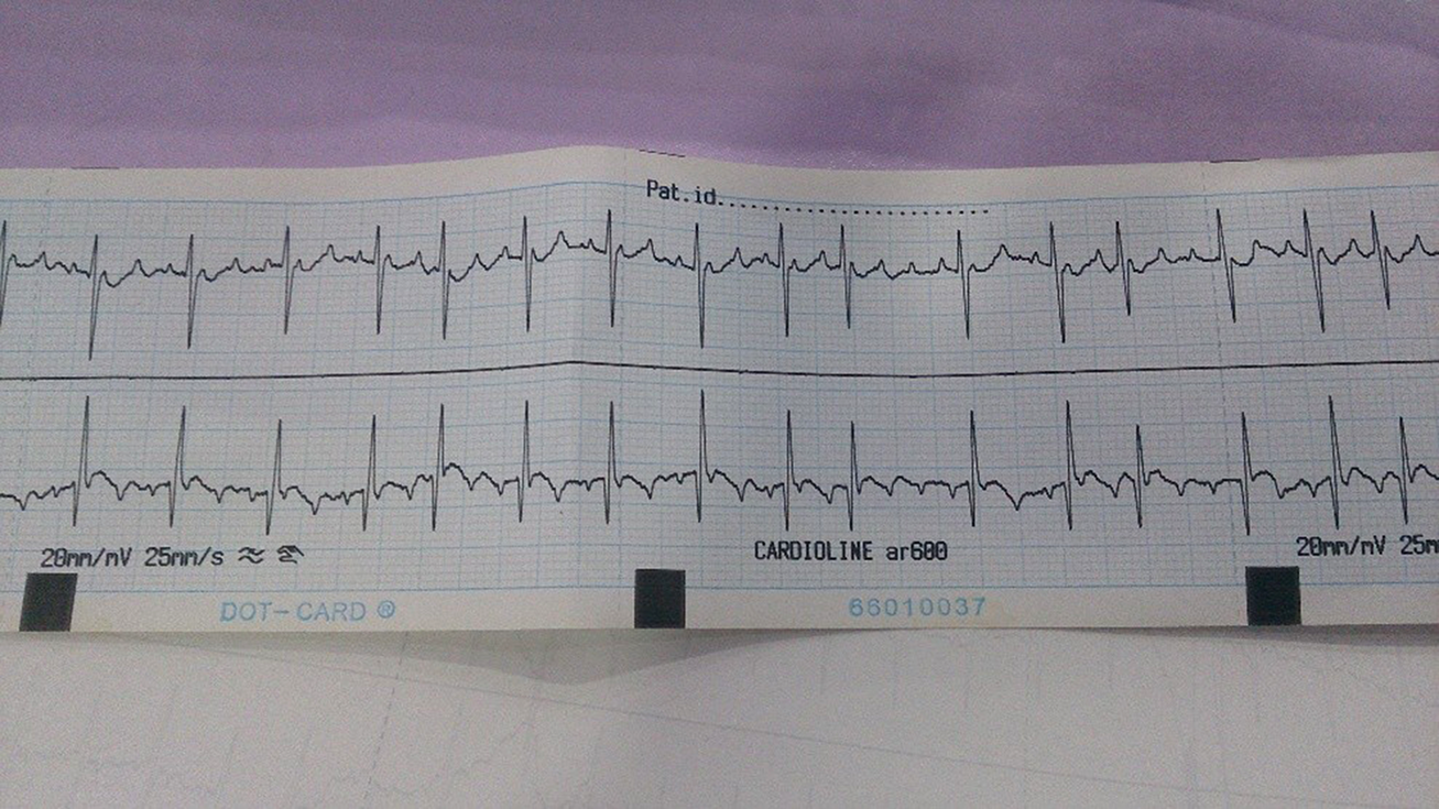 Results of Electrocardiogram After Birth: Ongoing AT with Ventricular Rate of Approximately 150 bpm and Atrial Rate of About 300 bpm with Variable AV Block