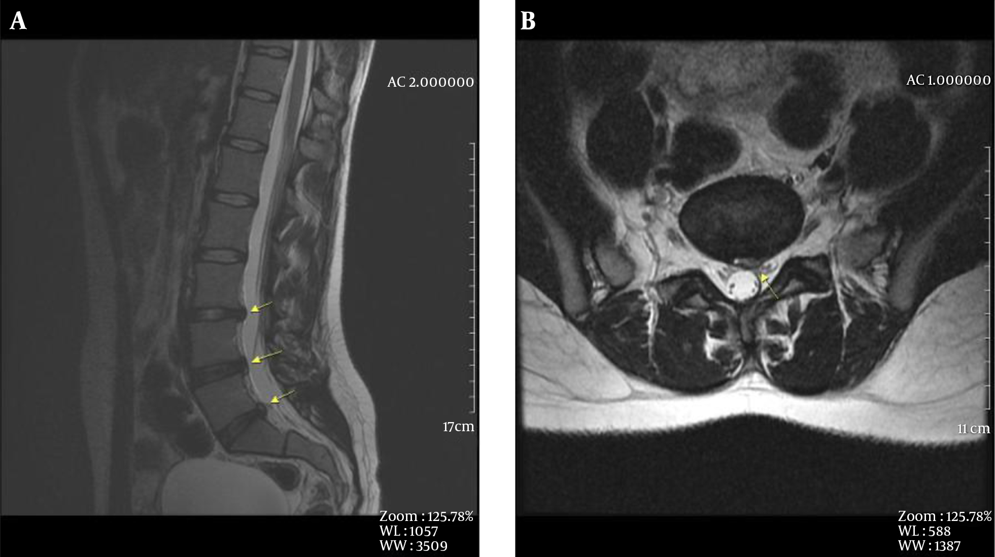 An 18 year-old woman, A, mid-sagittal T2W-FSE image, degenerative signal loss and disc protrusion are seen at L3-L4, L4-L5, L5-S1 intervertebral discs (arrow). Lumbar lordosis is preserved. B, Axial T2W-FSE image, central disc protrusion is seen at L5-S1 level.