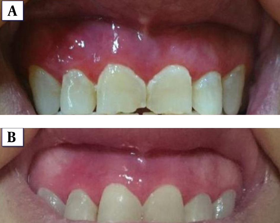 Comparison of the patient's gingiva before (A) and after (B) treatment
