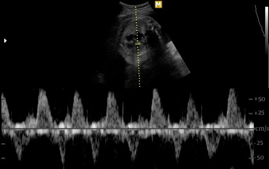 Results of Fetal Echocardiography: Supraventricular Tachyarrhythmia with a Ventricular Heart Rate of About 214 bpm and Atrial Heart Rate of 237 bpm and Some Degree of AV Block
